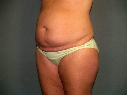 Tummy Tuck Before & After Patient #2417