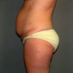 Tummy Tuck Before & After Patient #2417