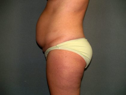 Tummy Tuck Before & After Patient #2417