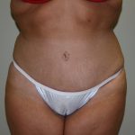 Tummy Tuck Before & After Patient #1961