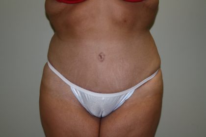 Tummy Tuck Before & After Patient #1961