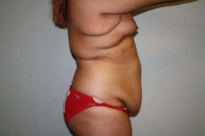 Tummy Tuck Before & After Patient #1961