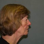 Facelift Before & After Patient #592
