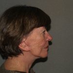 Facelift Before & After Patient #592