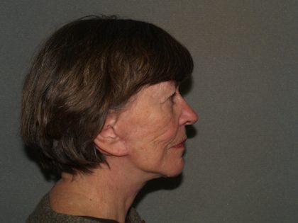 Facelift Before & After Patient #592