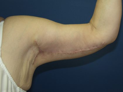 Arm Lift Before & After Patient #860