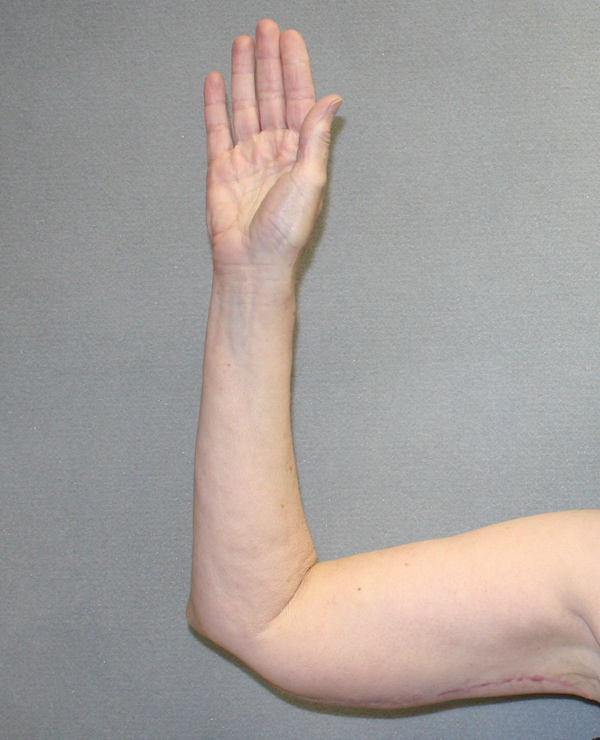 Arm Lift Before & After Patient #841