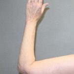 Arm Lift Before & After Patient #841