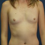 Breast Augmentation Before & After Patient #2724