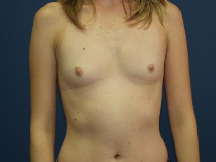 Breast Augmentation Before & After Patient #2724