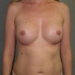 Breast Augmentation Before & After Patient #2724