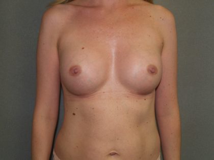 Breast Augmentation Before & After Patient #2724