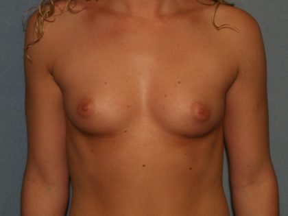 Breast Augmentation Before & After Patient #2612