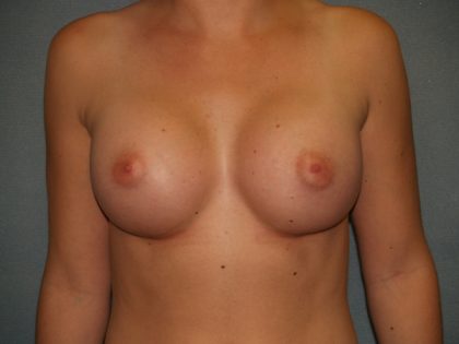 Breast Augmentation Before & After Patient #2612