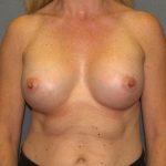 Breast Augmentation Before & After Patient #2503