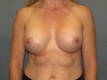 Breast Augmentation Before & After Patient #2503