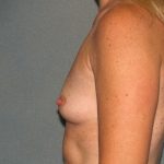 Breast Augmentation Before & After Patient #2503