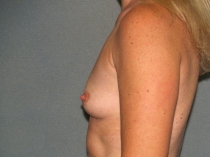 Breast Augmentation Before & After Patient #2503