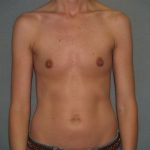 Breast Augmentation Before & After Patient #3173