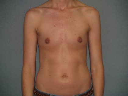 Breast Augmentation Before & After Patient #3173