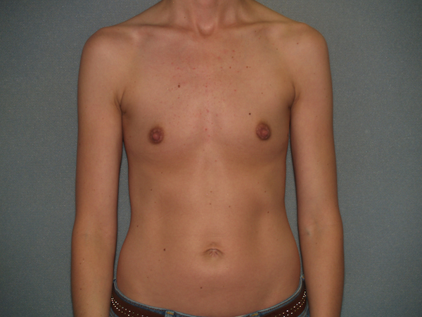 Breast Augmentation Before & After Patient #3173