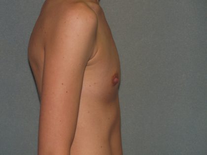 Breast Augmentation Before & After Patient #3173