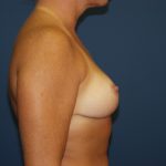 Breast Reduction Before & After Patient #3348