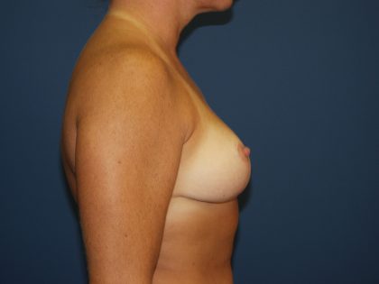 Breast Reduction Before & After Patient #3348