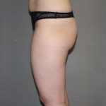 Brazilian Butt Lift Before & After Patient #445