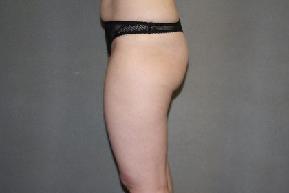 Brazilian Butt Lift Before & After Patient #445