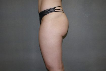 Brazilian Butt Lift Before & After Patient #445