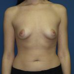 Breast Augmentation Before & After Patient #3222