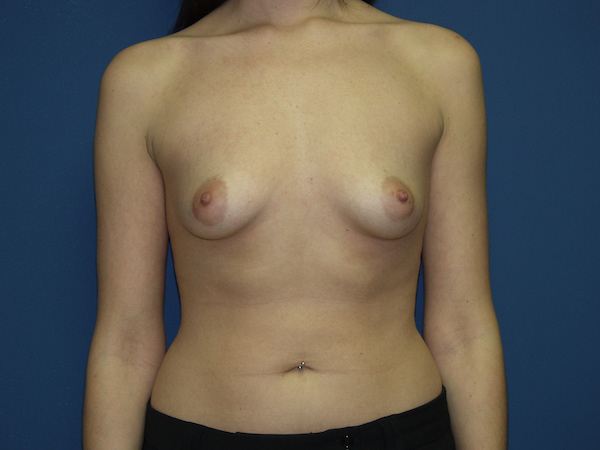 Breast Augmentation Before & After Patient #3222
