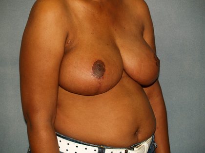 Breast Reduction Before & After Patient #3433