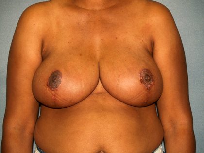 Breast Reduction Before & After Patient #3433