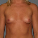 Breast Augmentation Before & After Patient #2475