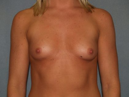 Breast Augmentation Before & After Patient #2475