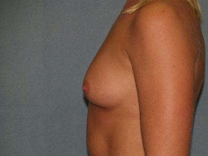 Breast Augmentation Before & After Patient #2475