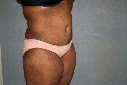 Circumferential Tummy Tuck Before & After Patient #891