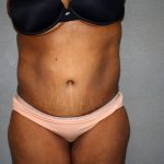 Circumferential Tummy Tuck Before & After Patient #891