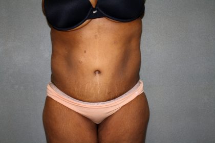 Circumferential Tummy Tuck Before & After Patient #891