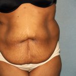 Circumferential Tummy Tuck Before & After Patient #891