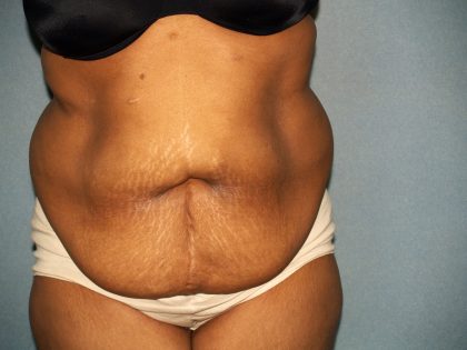 Circumferential Tummy Tuck Before & After Patient #891