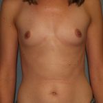 Breast Augmentation Before & After Patient #2524