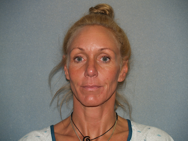Facelift Before & After Patient #599