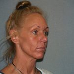 Facelift Before & After Patient #599
