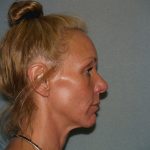 Facelift Before & After Patient #599