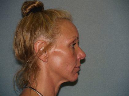 Facelift Before & After Patient #599