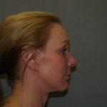 Facelift Before & After Patient #599
