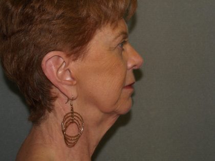 Facelift Before & After Patient #606